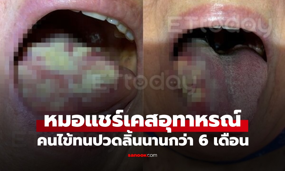 คนไข้ใจแข็งทนปวดลิ้น 6 เดือน แค่เดินเข้ามาหมอใจเสีย ได้กลิ่นที่ไม่มีใครอยากเจอ
