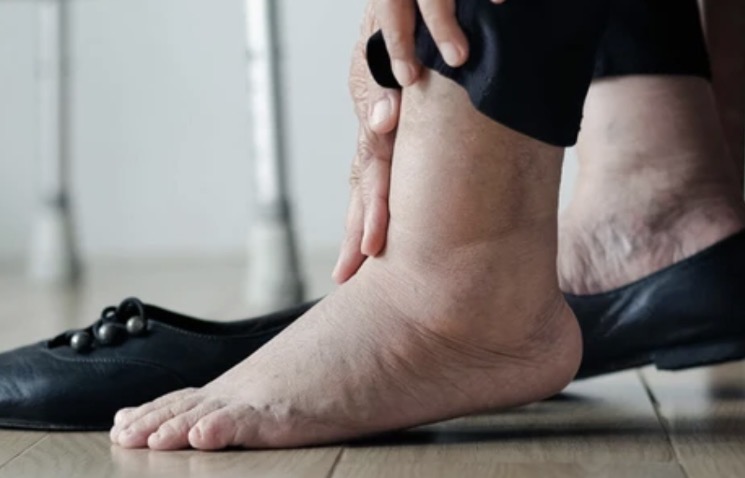 พบสัญญาณนี้ที่ “ข้อเท้า” โปรดระวัง โรคไต-หัวใจ ร่างกายกำลังตะโกนเตือน!!!