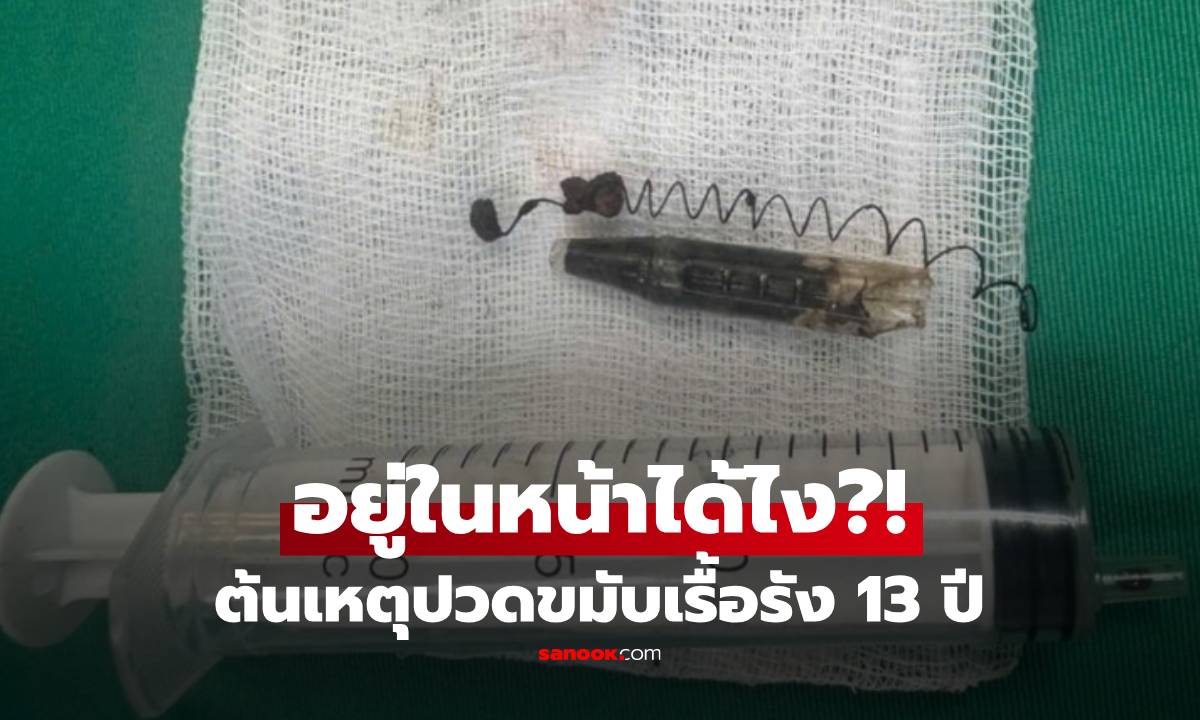 13 ปีที่หายไป! หนุ่มปวดหัวเรื้อรัง สุดท้ายเจอคำตอบ "สิ่งนี้" ฝังมิดอยู่ในหน้า