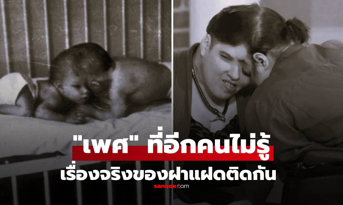 อึ้งทั้งโลก! ฝาแฝดติดกัน ซ่อน "เพศที่แท้จริง" กับอีกคน นานหลายสิบปี ทั้งที่อยู่ด้วยกันตลอด