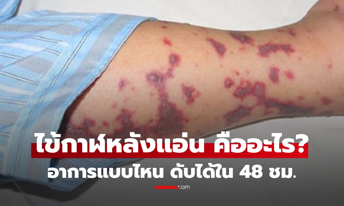 "ไข้กาฬหลังแอ่น" คืออะไร? ไทยพบผู้ป่วย-ดับแล้ว คร่าชีวิตไวใน 48 ชม. อาการแบบไหนต้องระวัง