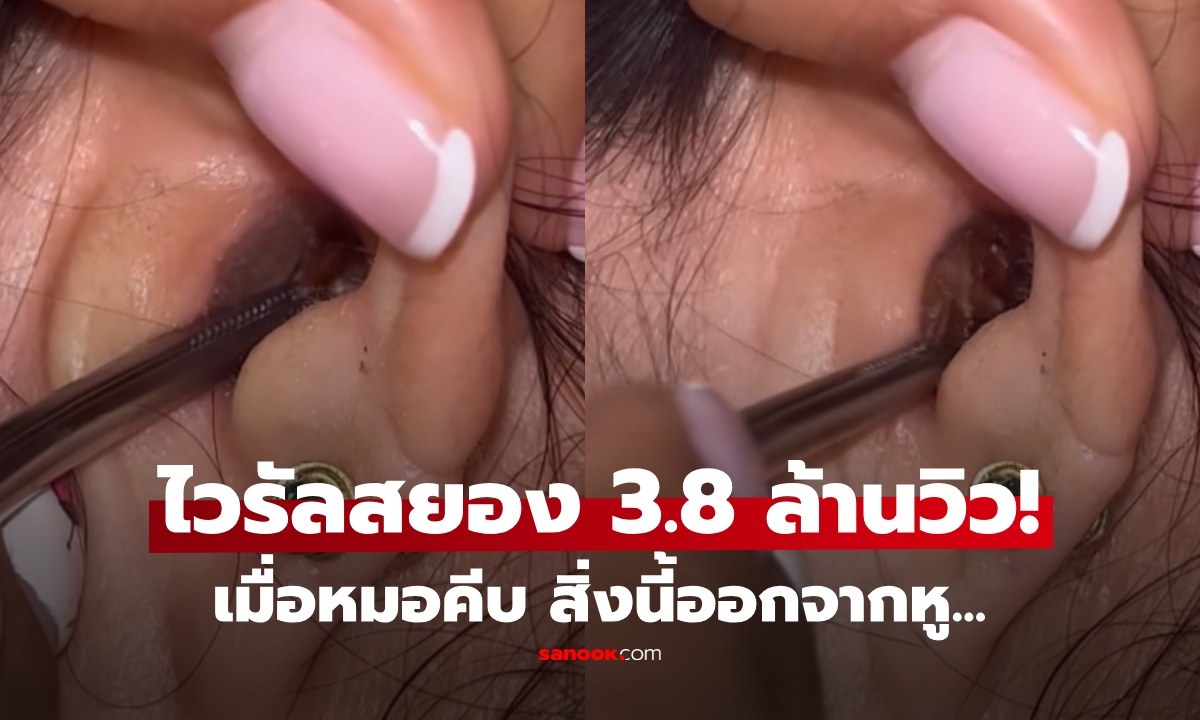 ปวดหูไม่หาย นึกว่าขี้หูตัน หมอคีบออกมา ขนลุกเกรียว! เจ้าตัวเองยังหันหน้าหนี