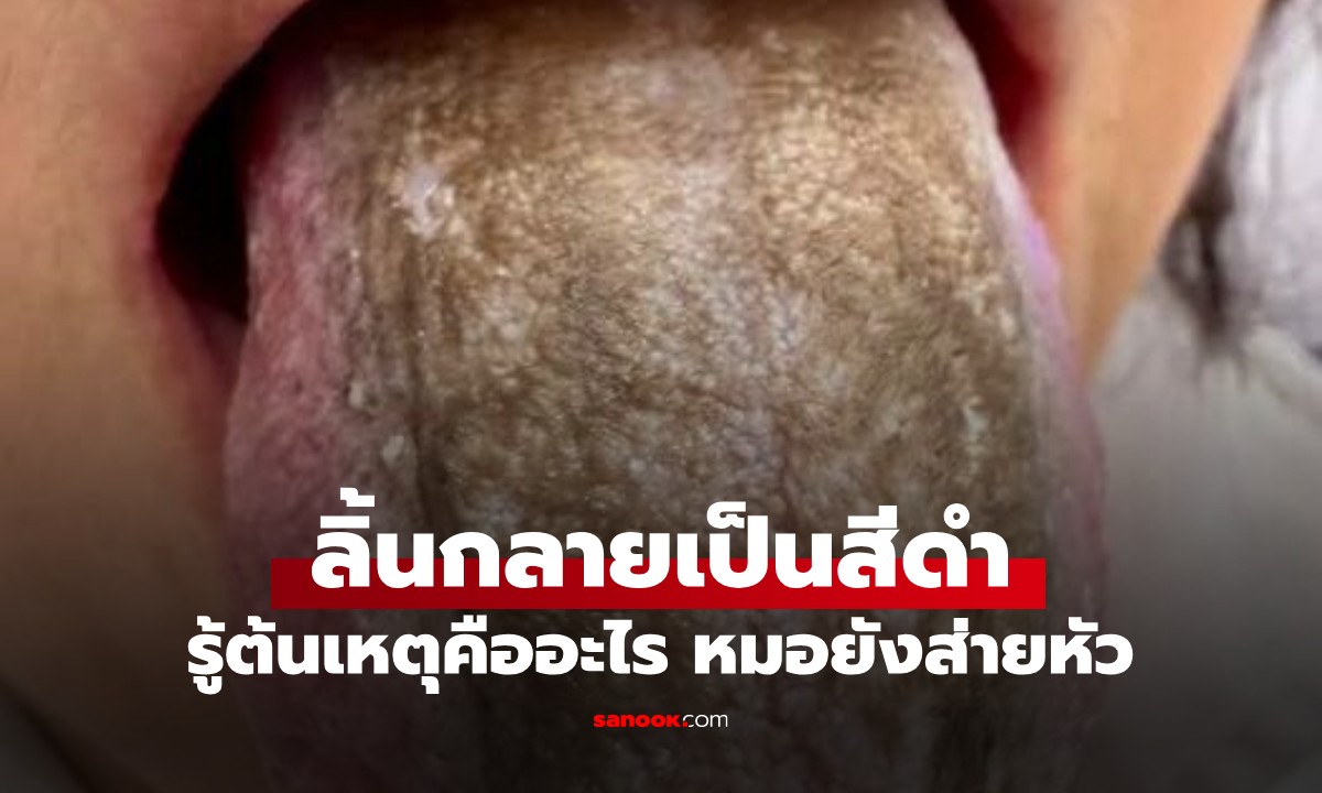 ขนลุกสยอง! คนไข้ลิ้นกลายเป็น "ป่าดำ" รู้ว่าใช้อะไรทุกครั้งหลังกินข้าว หมอยังส่ายหัว
