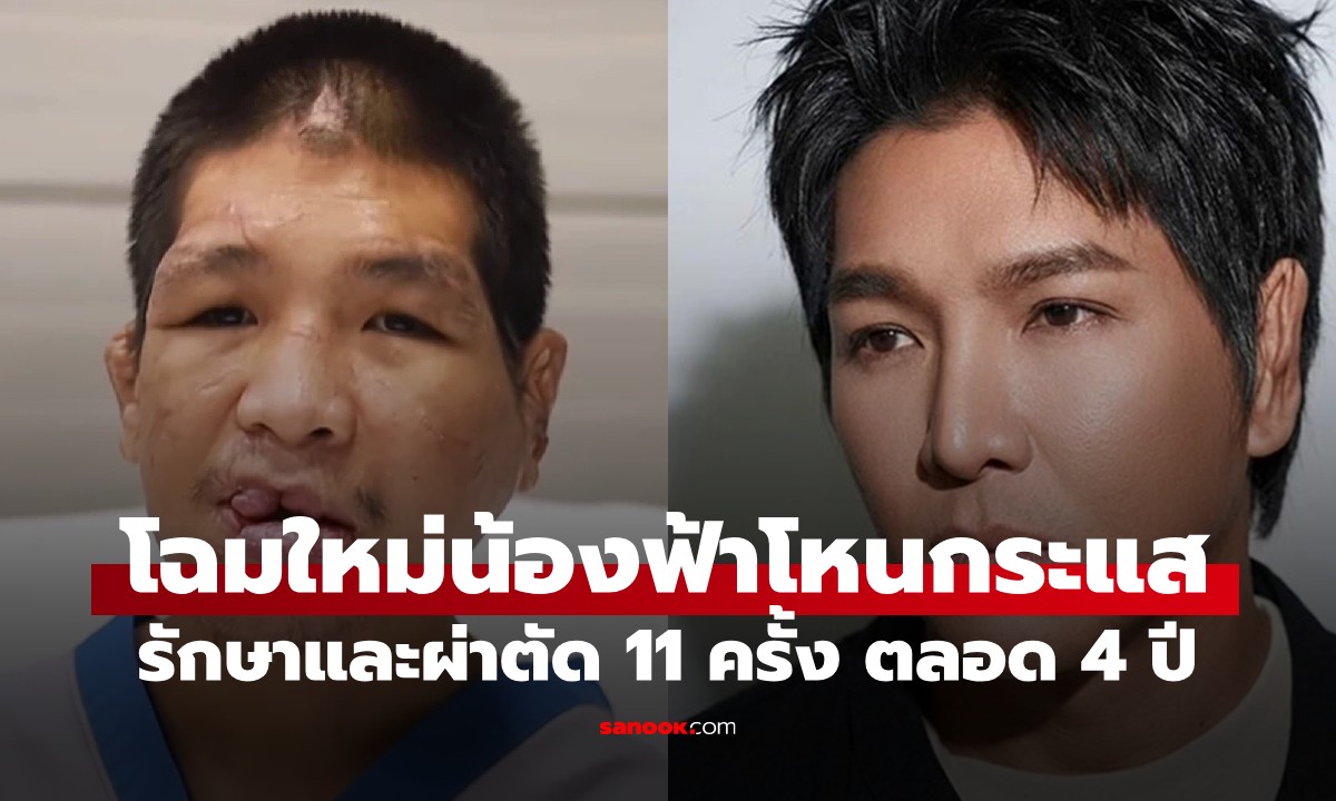 "น้องฟ้าโหนกระแส" เหยื่อนายจ้างทารุณ 15 ปี สู่การผ่าตัด 11 ครั้ง ผลลัพธ์สุดว้าว