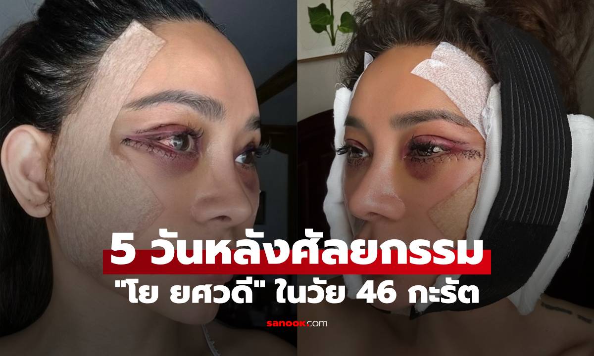 "โย ยศวดี" สวยฉ่ำ หน้าเด็กมาก เปิดภาพชัดๆ 5 วันหลังศัลยกรรมในวัย 46 กะรัต