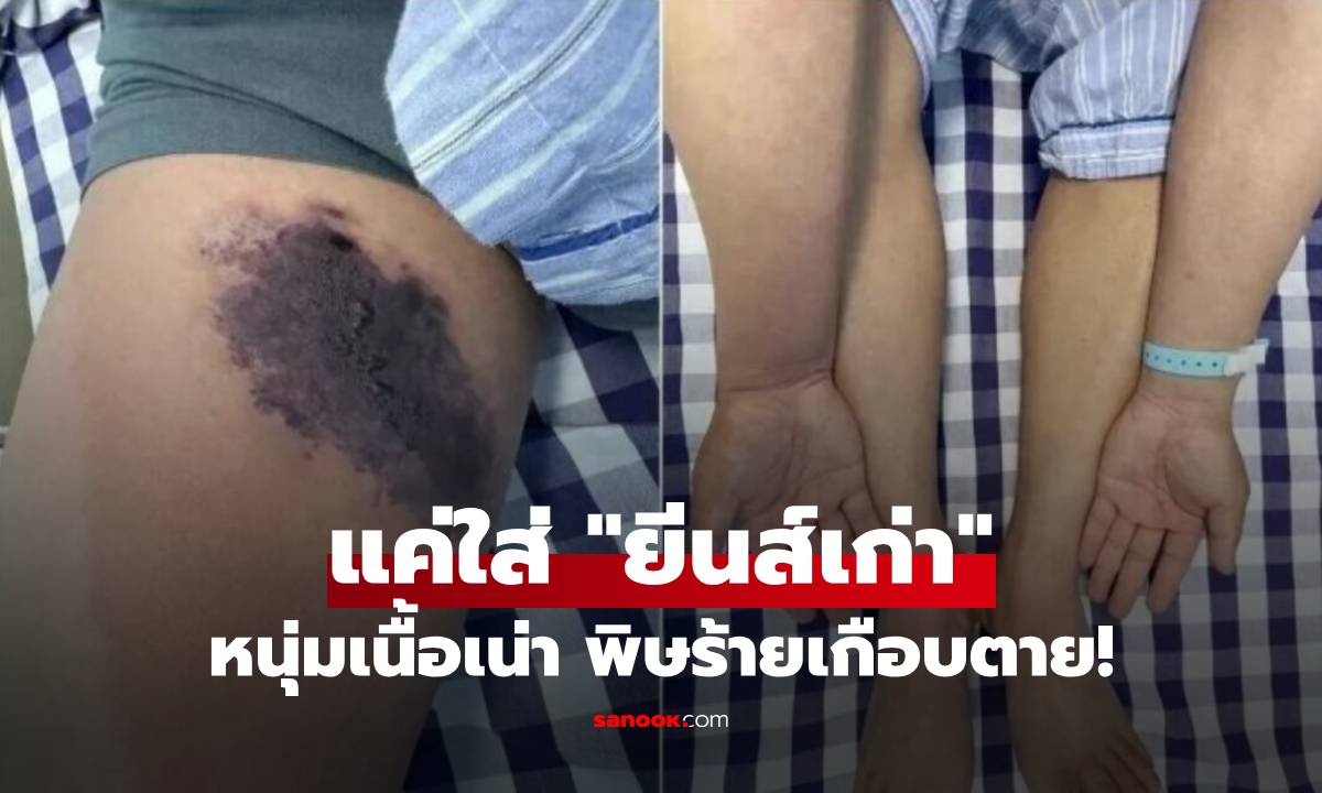 เตือนภัยใกล้ตัว! แค่ใส่กางเกงเก่า หนุ่มช็อก "เนื้อเน่า" เกือบดับเพราะพิษแพร่ทั่วร่าง