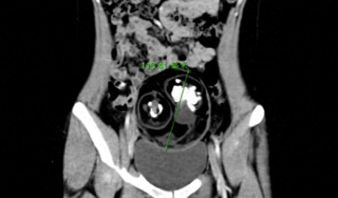 หมอผ่าท้องสาว 18 อึ้งเจอ "เนื้องอกมีฟัน 24 ซี่" ไม่ใช่ลูกประหลาด แต่คือโรคในผู้หญิง