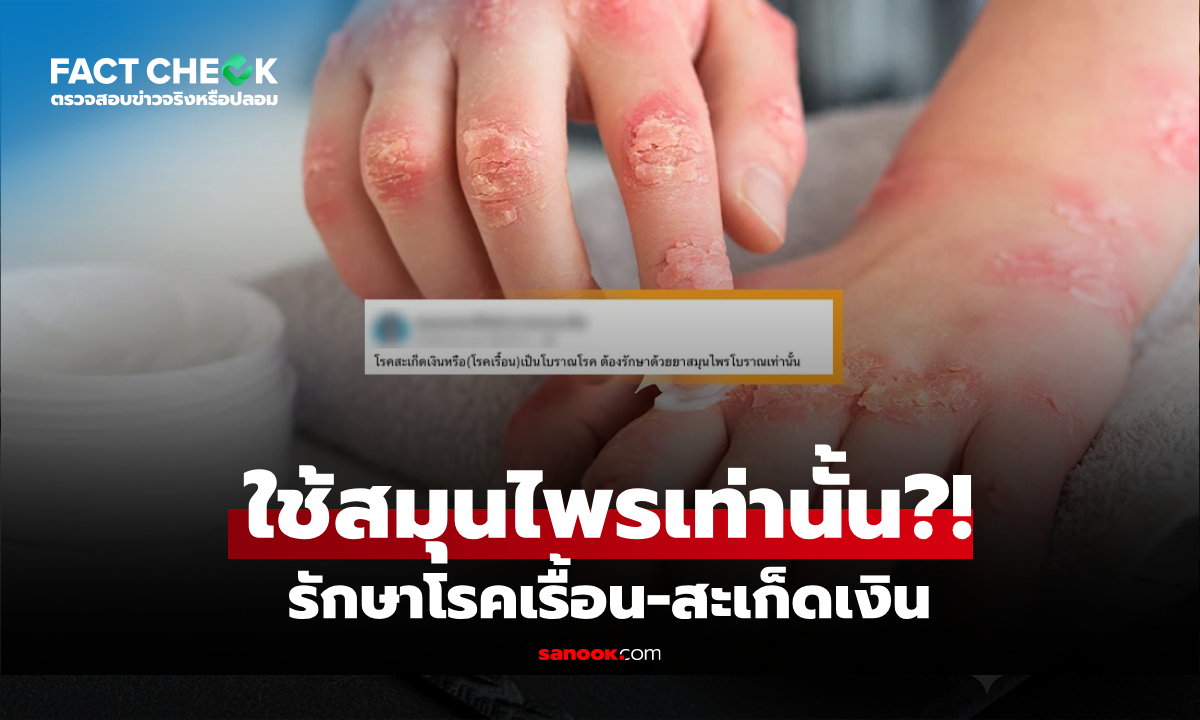 เฉลยแล้ว! โรคเรื้อน-สะเก็ดเงิน ต้องรักษาสมุนไพรเท่านั้น จริงหรือไม่? : เช็กข่าวชัวร์