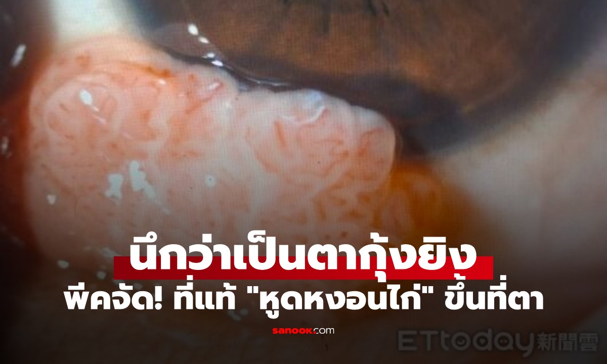 อุทาหรณ์สายเบิร์น! นึกว่าเป็นตากุ้งยิง 3 เดือนไม่หาย พีคหมอพบ "หูดหงอนไก่" ขึ้นตา