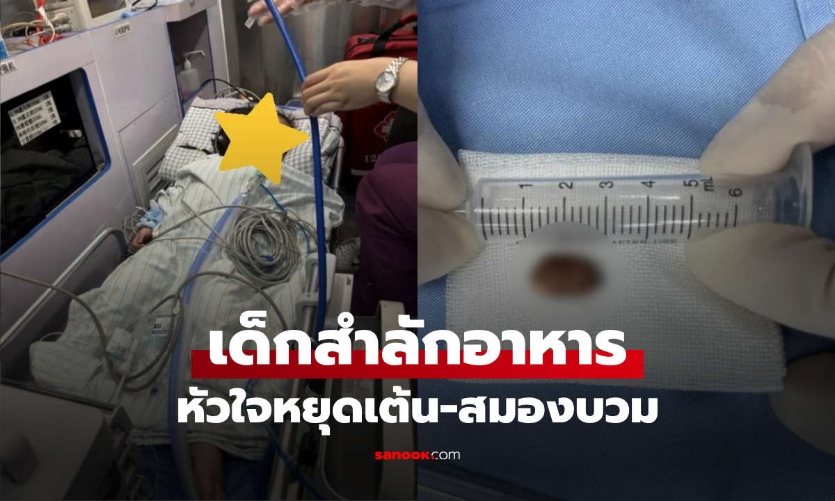 เด็ก 2 ขวบ หัวใจหยุดเต้น-สมองบวม หมอพบ "สิ่งนี้" ติดในหลอดลม อุทาหรณ์สำลักอาหาร!