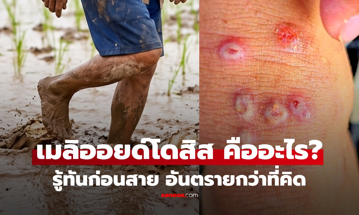 รู้ทันก่อนสาย! "โรคเมลิออยด์โดสิส" คืออะไร? พบดับแล้ว 23 ราย อาการคล้ายหวัด แต่อันตรายกว่าที่คิด