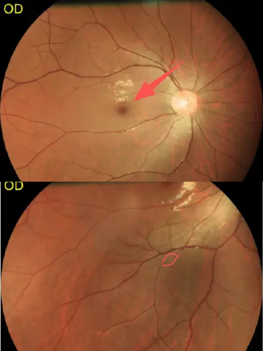 ชานม ตัวลายทำตาบอดชั่วคราว