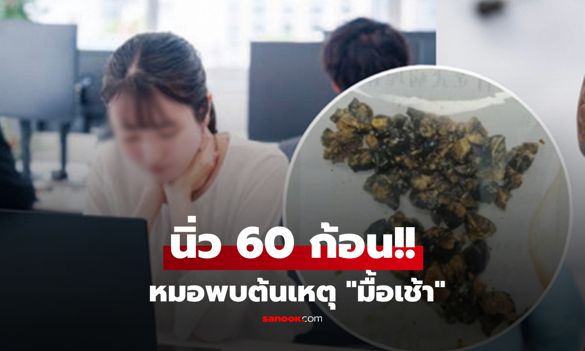 ปวดจนยืนตรงไม่ได้!! มื้อเช้าเป็นเหตุ สาวผ่าเจอ "นิ่ว" เต็มถุงน้ำดี แพทย์นับจำนวนยิ่งช็อก