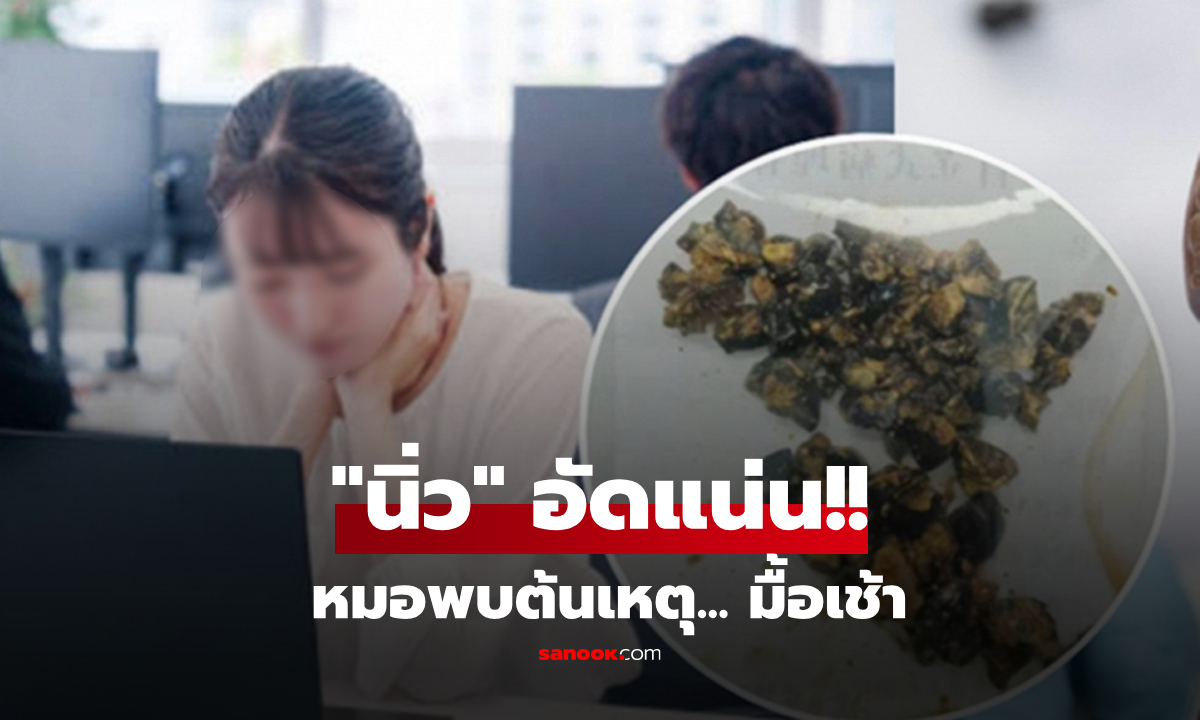 ปวดจนยืนตรงไม่ได้!! มื้อเช้าเป็นเหตุ สาวผ่าเจอ "นิ่ว" เต็มถุงน้ำดี แพทย์นับจำนวนยิ่งช็อก