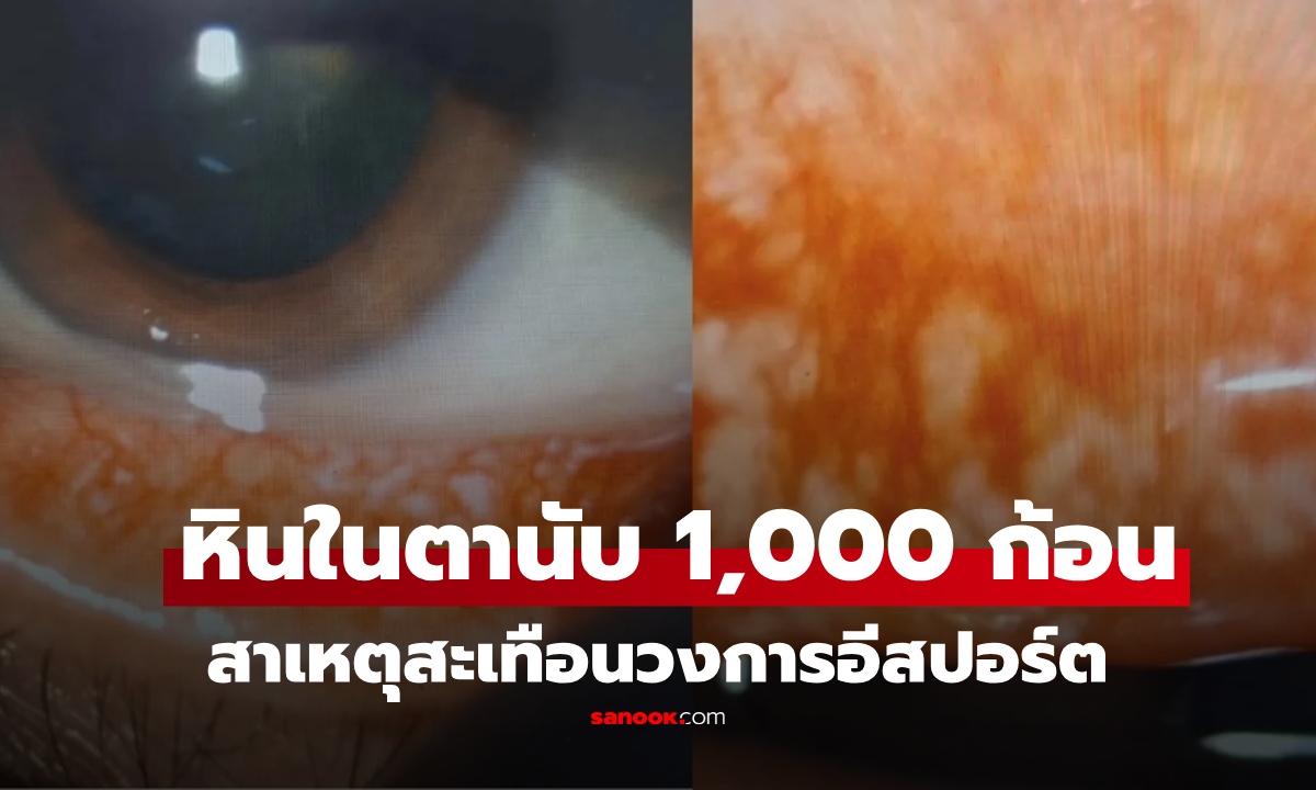 นักกีฬาอีสปอร์ต เจ็บตาเหมือน "ถูกแทง" อึ้ง พบ "หินในตา" นับ 1,000 หมอชี้เหตุ สะเทือนทั้งวงการ!