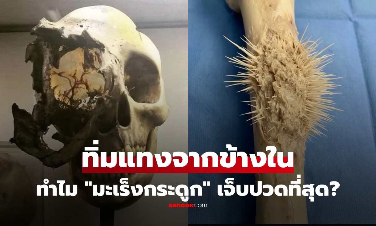 มอร์ฟีนก็เอาไม่อยู่! "มะเร็งกระดูก" ภาพจริงที่ไม่มีใครอยากเห็น หนามแหลมทิ้มทรมานทีสุด