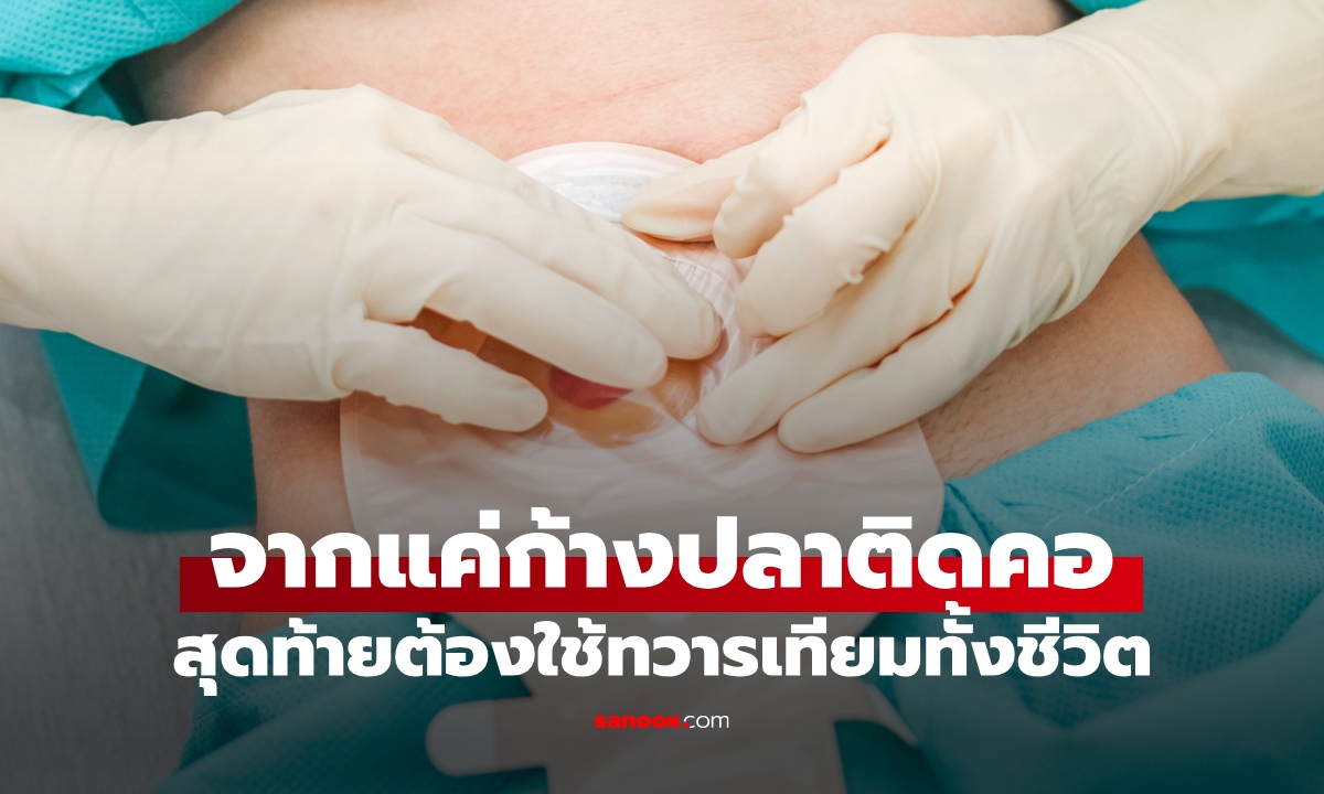 ก้างปลาติดคอ เชื่อโบราณกลืนข้าวคำโตๆ สุดท้ายต้องใช้ "ทวารเทียม" ตลอดชีวิต