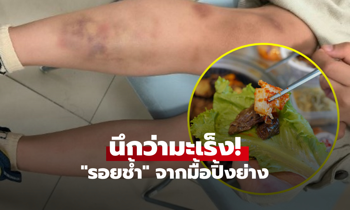 น่ากลัวมาก! เด็ก 6 ขวบ "รอยช้ำเต็มตัว" หมอตรวจแล้วรีบถาม กินปิ้งย่างกับผักอะไร?!!