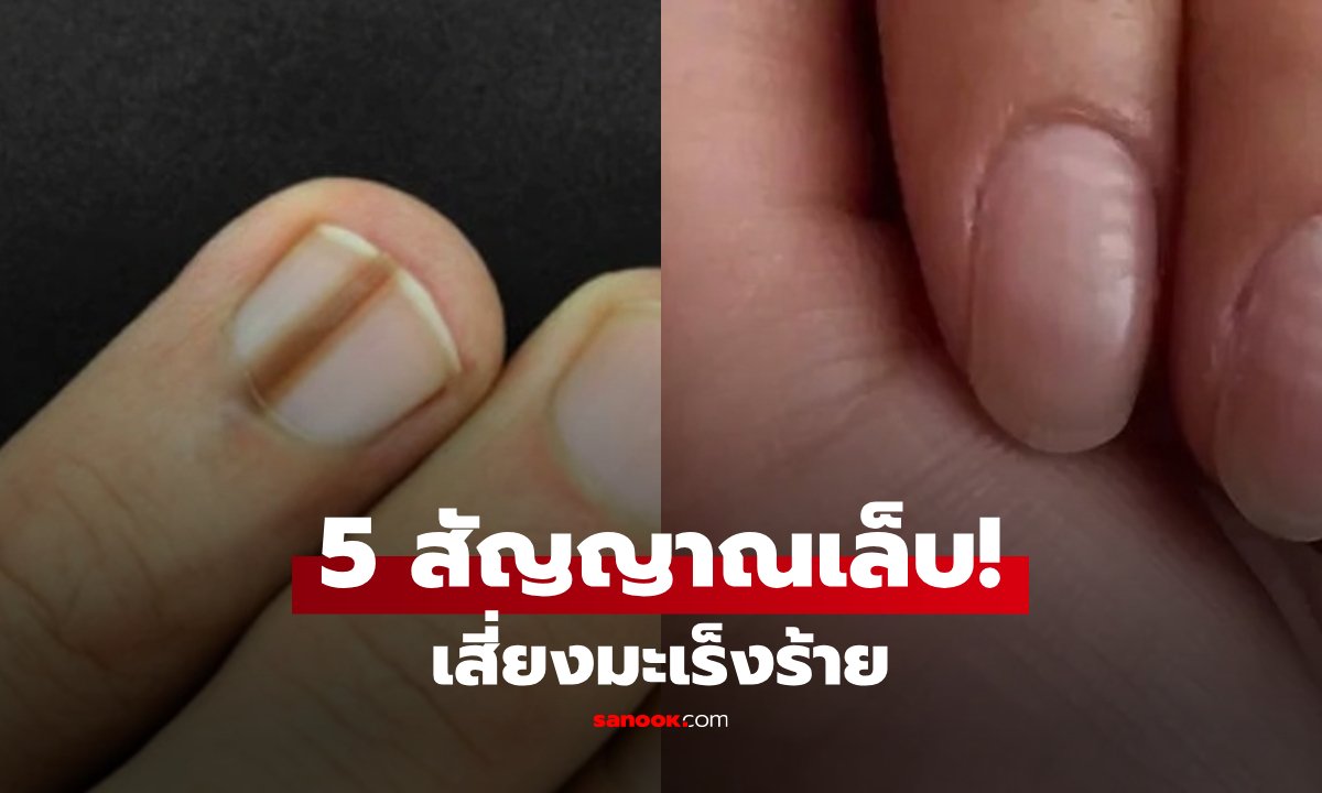 หมอเตือน! 5 สัญญาณอันตราย "เล็บ" ที่เสี่ยงมะเร็งร้าย เผยเคสชายวัย 60 ปล่อยไว้จนสยอง
