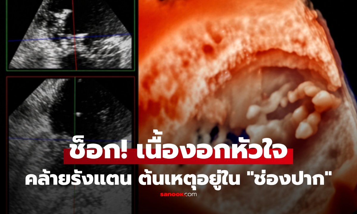 สะพรึง! "ก้อนรังแตน" กินหัวใจชายวัย 51 ลามสมอง-ไต หวิดดับ ก่อนพบต้นเหตุจาก "ช่องปาก"