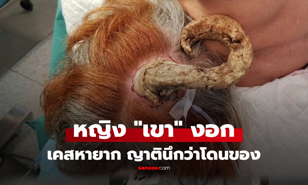 หญิงวัย 75 "เขาปริศนา" งอกท้ายทอย หมอผ่าออกดู อึ้ง! พบความจริงซ่อนใต้ฐาน ต้นเหตุเขางอก