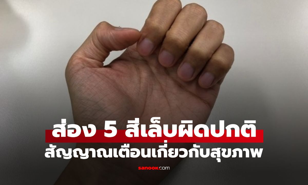 5 สีเล็บอันตราย! หมอเตือน "เล็บเปลี่ยนสี-นิ้วปุ้ม" สัญญาณเตือนที่ไม่ควรมองข้าม