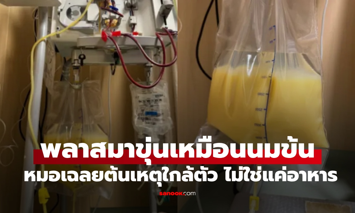 เฉียดตาย! สาววัย 32 พลาสมาขุ่นเหมือนนมข้น หมอเฉลยต้นเหตุใกล้ตัว ไม่ใช่แค่อาหาร