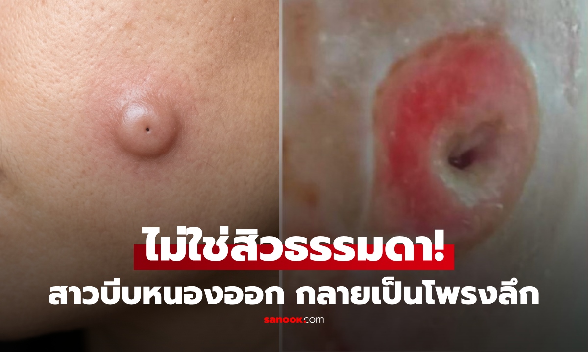 สาวเจอตุ่มบนแก้ม บีบออกเอง ช็อก! กลายเป็นโพรงลึก ลามติดเชื้อหนัก หมอชี้ "ไม่ใช่สิวธรรมดา"