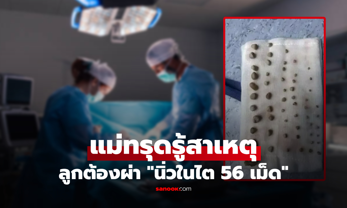 ป.4 ปวดท้องจนทรุด ช็อก "นิ่วในไต 56 เม็ด" จากอาหารโปรด แม่ใจสลายหน้าห้องผ่าตัด!
