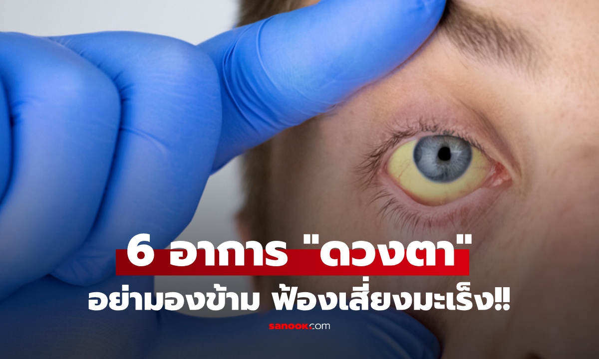 อย่ามองข้าม! 6 อาการ ผิดปกติที่ "ดวงตา" ภัยเงียบเตือน "มะเร็ง" ใครมีพบแพทย์ด่วน