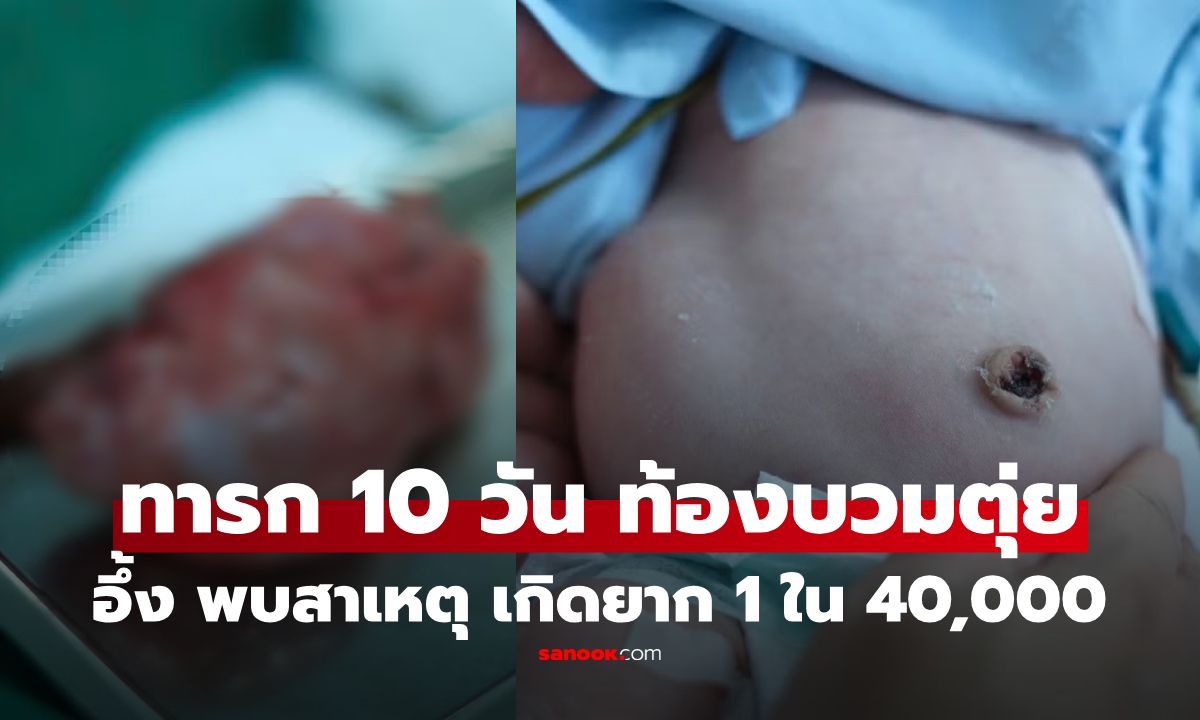 แม่แทบช็อก ลูกอายุ 10 วัน ท้องบวมใหญ่ ก่อนแพทย์เจอ "ก้อน" หายากกดทับภายใน หวิดไม่รอด