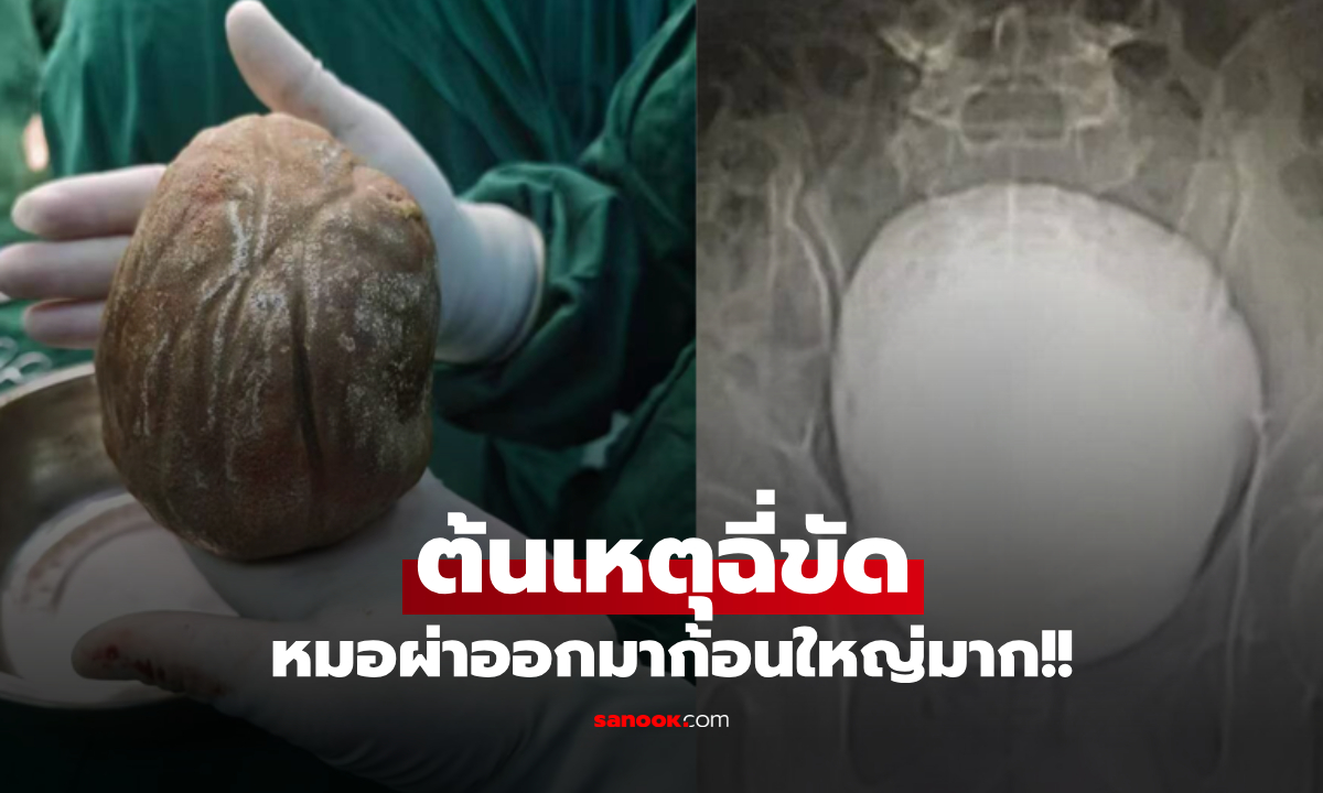 แพทย์อึ้งทั้งทีม! หนุ่มทน "ปัสสาวะขัด" นาน 3 ปี สุดท้ายผ่าเจอ "สิ่งนี้" หนักทะลุ 1.3 กิโล