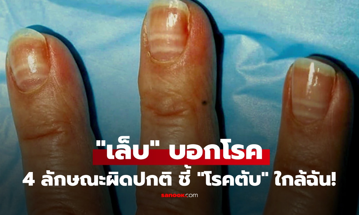 ดูเล็บก็รู้! 4 ลักษณะ "เล็บ" ผิดปกติ สัญญาณเตือน "ตับ" กำลังมีปัญหา