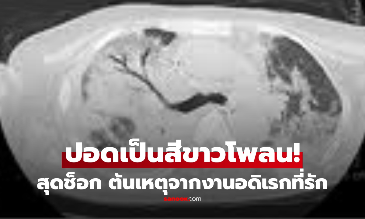ตะลึง! ภาพสแกนปอดชายขับรถบรรทุก "ขาวโพลน"  ทั้งตับ-ไต ก็เสียหาย พบต้นเหตุจากงานอดิเรกที่รัก