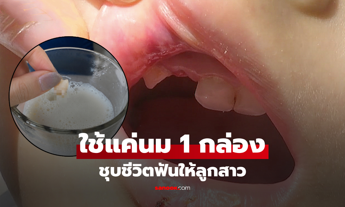 ลูกล้มฟันหน้าหลุด พ่อแม่ใช้ "นมกล่องเดียว" ฟื้นคืนชีพให้ หมอยังเอ่ยปากชมฉลาดมาก!!
