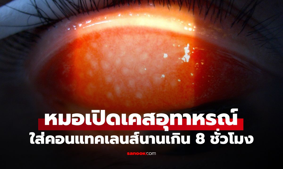 สยองสายคอนแทคเลนส์! ใส่เกิน 8 ชม. เปิดเปลือกตาเจอ "ตุ่มโผล่พรึบ" อักเสบหวิดพัง