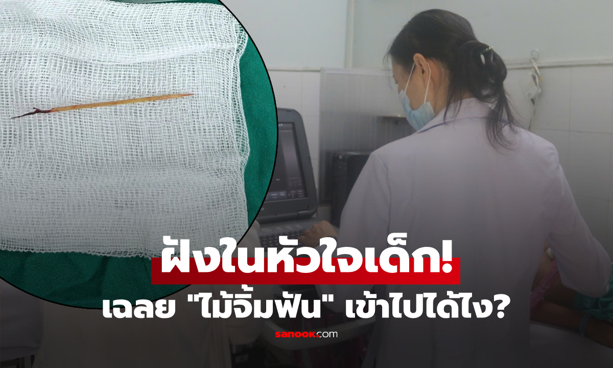 เข้าไปได้ไง? แพทย์ช็อกทั้งทีม ผ่าเจอ "ไม้จิ้มฟัน" ฝังในหัวใจเด็กชายวัย 13 แทงทะลุหวิดดับ!