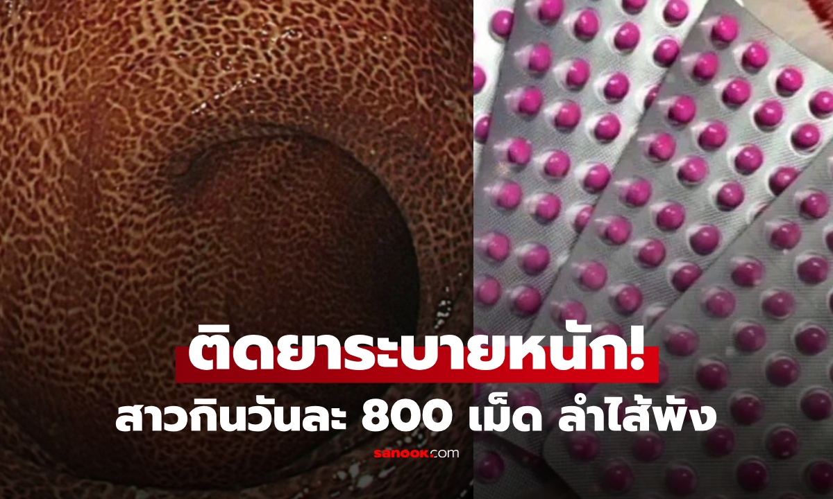 อึ้ง! เผยภาพถ่ายลำไส้ สาวกินยาระบาย 4 ปี 