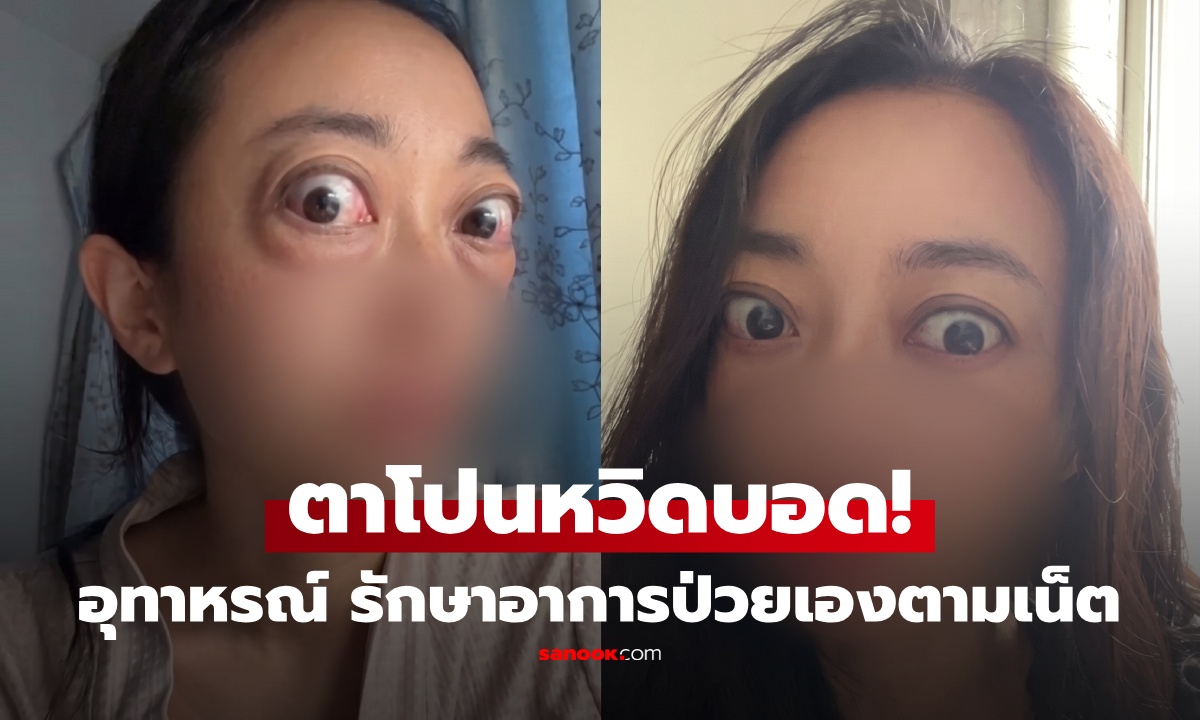 สาววัย 34 เผยบทเรียนรักษาโรคเองตามเน็ต สุดท้ายตาโปน หวิดบอด