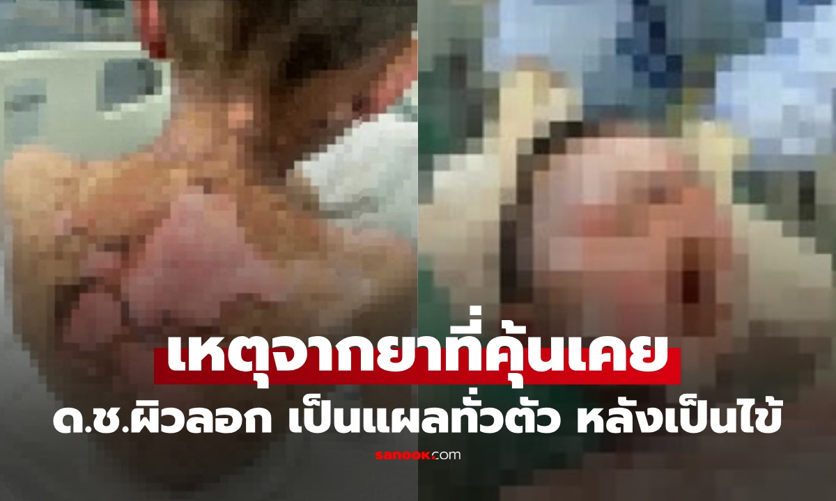 ด.ช. 9 ขวบ ผิวหนังลอก เป็นแผลทั่วร่างเหมือนถูกไฟไม้ หมอเฉลย ต้นเหตุจาก "ยา" ในบ้าน ที่พ่อแม่ให้