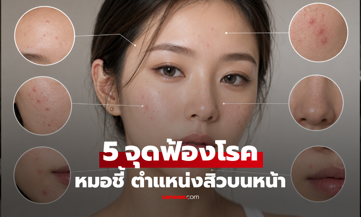 หมอเปิด 5 ตำแหน่ง "สิว" บนใบหน้า ฟ้องปัญหาสุขภาพ ในหัวใจ-ตับ-ปอด และมดลูก?