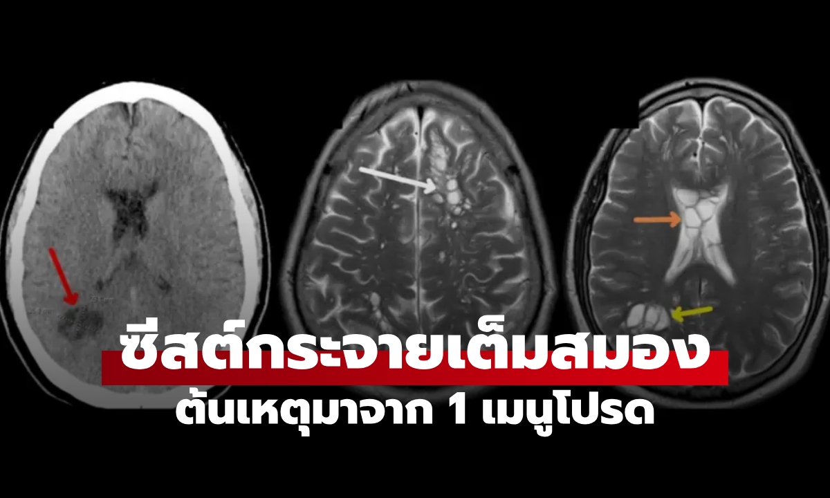 ชายปวดหัวนึกว่าไมเกรน ซีทีสแกนแล้วอึ้ง "ซีสต์เต็มสมอง" ต้นเหตุจาก 1 เมนูโปรด