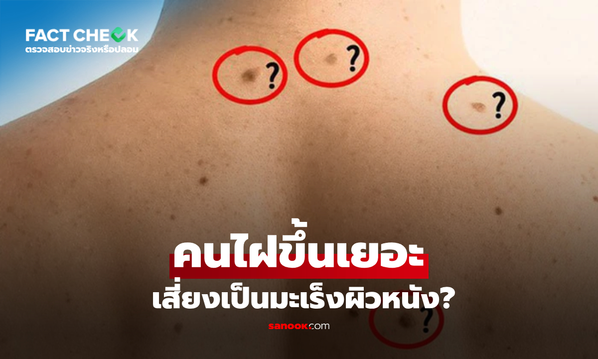 ไฝขึ้นเยอะเสี่ยงเป็น "มะเร็งผิวหนัง" จริงไหม? หมอเผยสูตรดูลายไฝอันตราย : เช็กข่าวชัวร์
