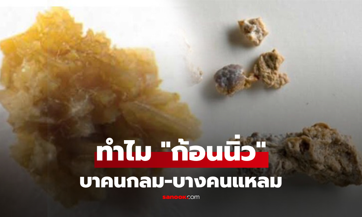ทำไม "ก้อนนิ่วในไต" บางคนกลมเกลี้ยง บางคนแหลมคล้ายปะการัง ต่างกันอย่างไร?