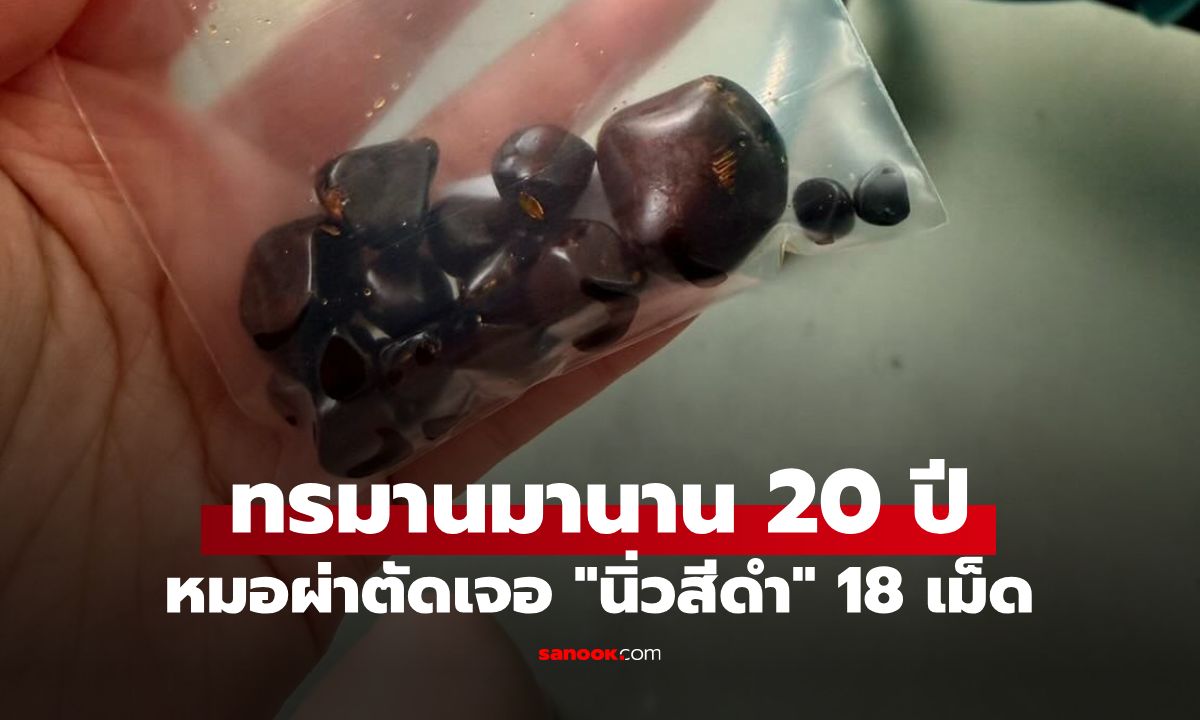 ซีอีโอร้อยล้านป่วยทรมาน 20 ปี หมอผ่าเจอ "นิ่วสีดำ" 18 เม็ด เหตุจากนิสัยการกิน