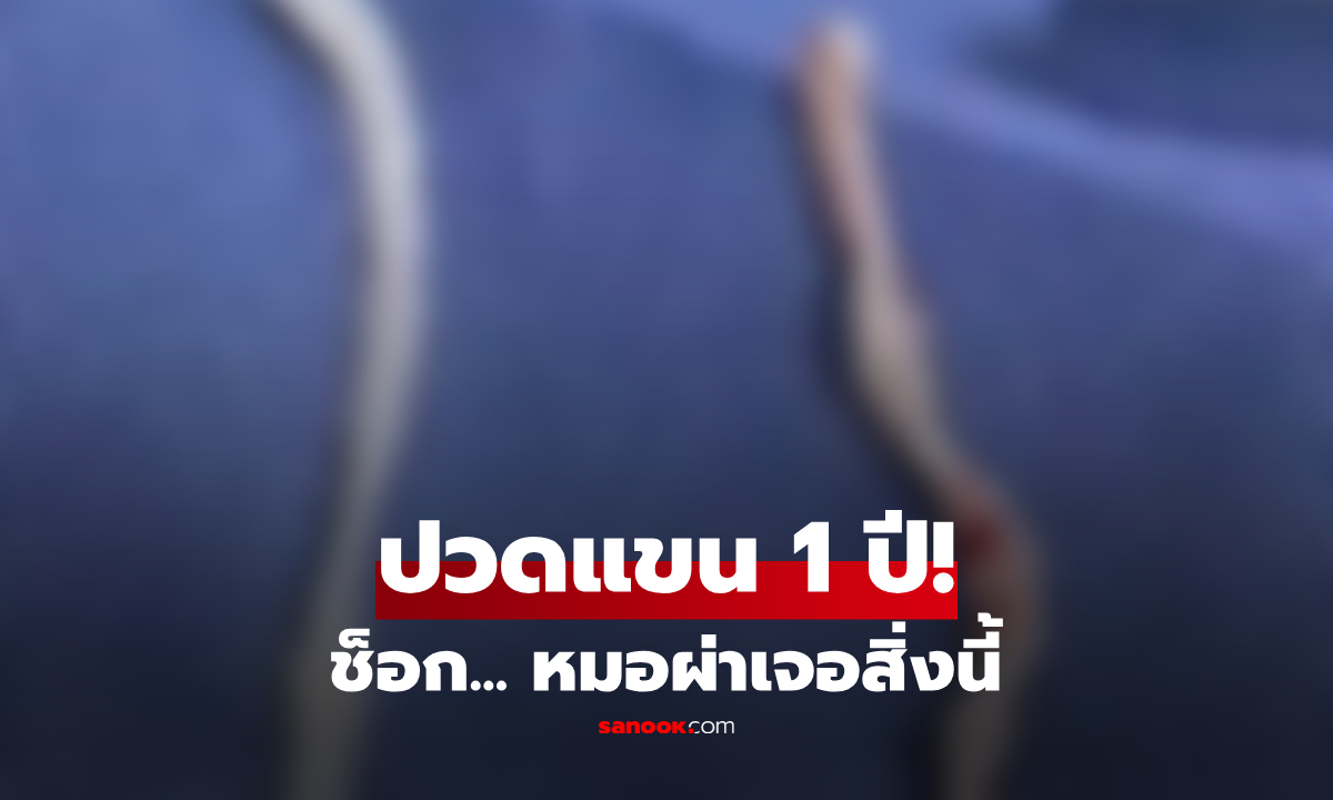 ปวดแขนนาน 1 ปี! สาวช็อกหมอผ่าเจอ "สิ่งมีชีวิต" ยาว 10 ซม. ซ่อนใต้ผิวหนังถึง 2 ตัว