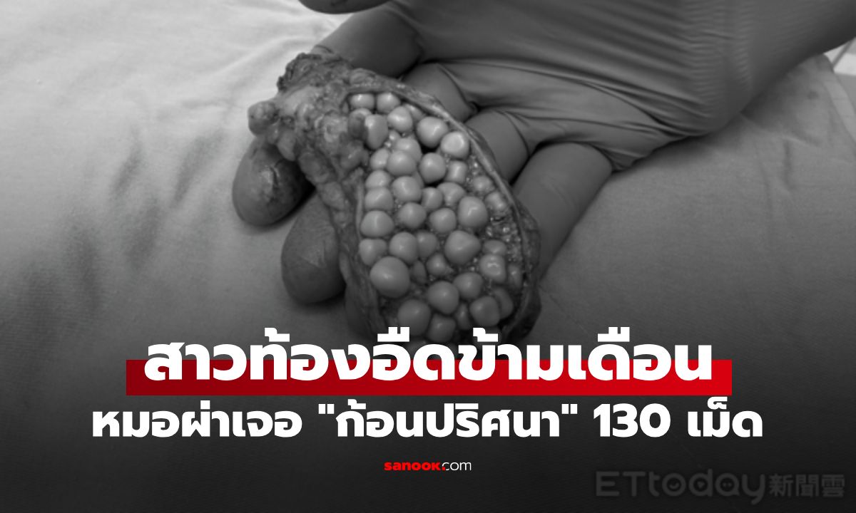 สาวท้องอืดข้ามเดือน หมอผ่าเจอ "ก้อนปริศนา" ทะลัก 130 เม็ด แน่นเต็มนึกว่าน้อยหน่า