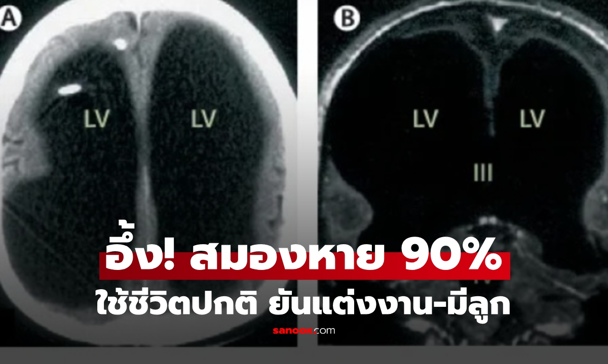 ชายวัย 44 ขาอ่อนแรงไปหาหมอ ก่อนพบความจริง หมอยังอึ้งสมองหายกว่า 90% ทำไมใช้ชีวิตได้!