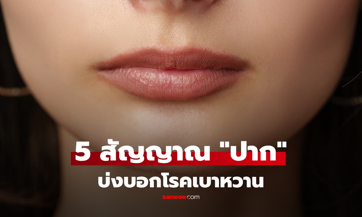 เปิด 5 สัญญาณจาก "ปาก" ชี้เสี่ยงเป็น "เบาหวาน" ข้อ 1 พบในผู้ป่วยถึง 49%