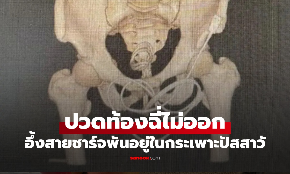 ไม่เชื่อก็ต้องเชื่อ ภาพเอกซเรย์สุดอึ้ง  "สายชาร์จ" ยาว 80 ซม. พันอยู่ในกระเพาะปัสสาวะ